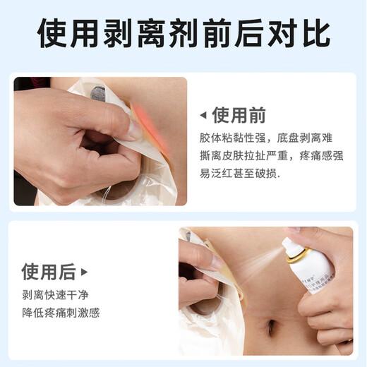 Enfermera compañera de clase Ostomy Pocket Chassis Adhesivo Spray Spray Medical Viscose Remover Stoma Care Products Remover Viscose [50 ml/botella] Remover adhesivo de chasis 12010