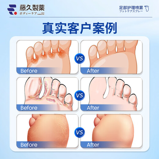 Fujiku Pharmaceutical Athlete's Foot Spray Anti-itching Peeling Rotten Feet Fungal Infection Foot Odor Spray Feet Sweating Foam Deodorizing Itching 60ml