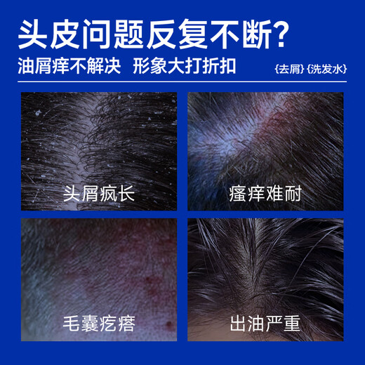 尊蓝1%二硫化硒去屑洗发水200g去屑止痒控油蓬松头皮清爽洗发露男女士