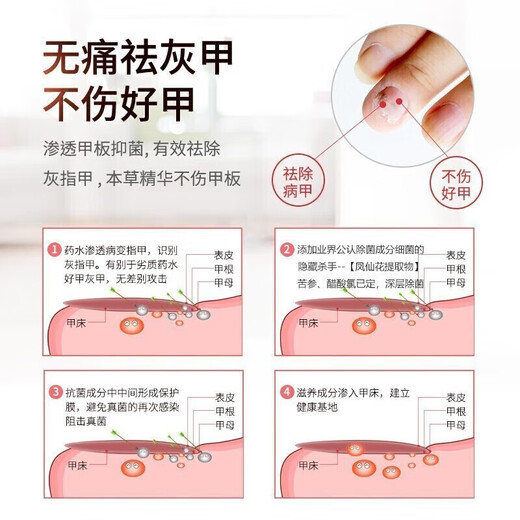 Lejia old store Nanjing Tongrentang special plaster for treating severe onychomycosis, nail fungus infection onychomycosis antibacterial liquid