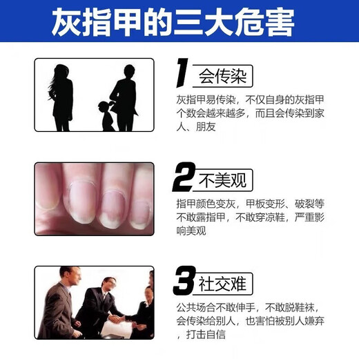 Lejia old store Nanjing Tongrentang special plaster for treating severe onychomycosis, nail fungus infection onychomycosis antibacterial liquid