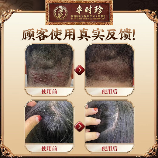 
Li Shizhen Pure Chinese Medicine Seborrheic Dermatitis Shampoo for Medical Scalp Itchy Non-Special Scalp Shampoo Hair Loss Non-Odd ointment 1 bottle [Purified Chinese Medicine, Seborrheic Scalp Follicles] Pure Chinese Medicine Special Effects