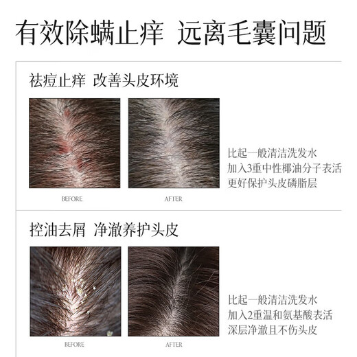 Importiertes Haarfollikel-Shampoo Entfernung von Milbenkontrolle und Ölkontrolle, Anti-Dandruff, Anti-Chein-Reinigungshampoo für Männer und Frauen 300 ml*2 Flaschen