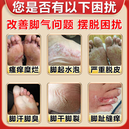 Yunnan Materia Medica special 100% special spray for sweaty feet and stinky feet to prevent and remove stinky feet, sore feet, sweaty feet, athlete's foot artifact antibacterial spray, medicated spray, buy 2 get 1 free, long-term foot odor and foot sweat