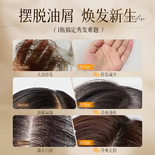 NULAD [Imported in Switzerland] Selenium disulfide anti-dandruff shampoo anti-itchi removal mite control oil control shampoo for men and women [Imported in Switzerland] Selenium disulfide shampoo 1 bottle