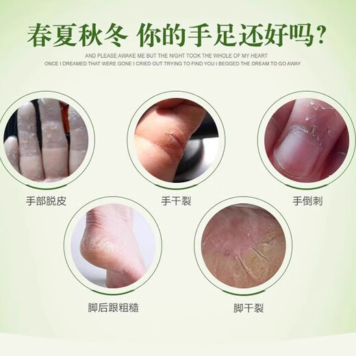 香港大药房手足脱皮膏季节性蜕皮手上起小水泡手痒脱皮干裂口起皮 1支SN6189 1支
