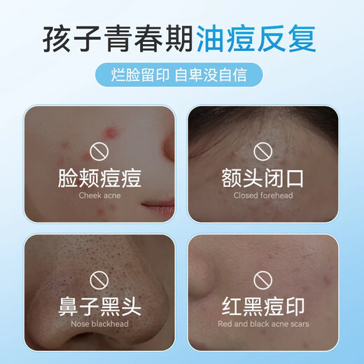 Chuman Youth Amino Acid Facial Cleanser 12-16 Years Old Boys and Girls Oil Control, Acne Removal and Blackheads Unisex Facial Cleanser Youth Specialization Vitamin C Facial Cleanser * 1 Bottle Donglai's Popular Teenage Facial Cleanser Best-Selling List TOP