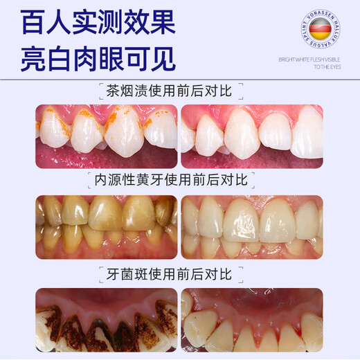 
Warronson Medical Teeth Whitening Remove Yellowing Teeth Beautifier Cold Light Whitening Artifact Gel Patch Teeth Cleaner Remove Tartar Stains