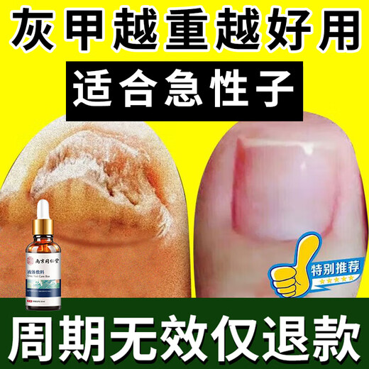 Lejia old store Nanjing Tongrentang special plaster for treating severe onychomycosis, nail fungus infection onychomycosis antibacterial liquid