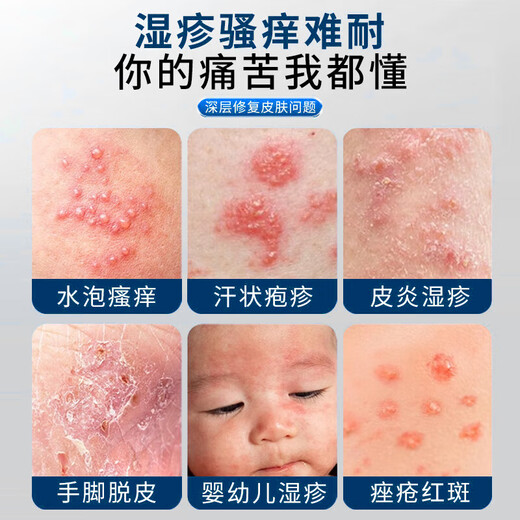 XIBELAON Germany specializes in eczema ointment eczema itchy skin dermatitis dermatitis fungal infection antipruritic cream special gel