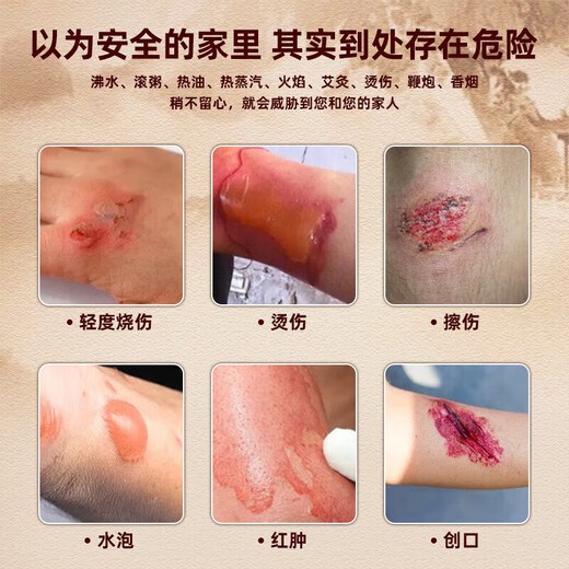 Yunzutang burn ointment for blistering, red and swollen wounds