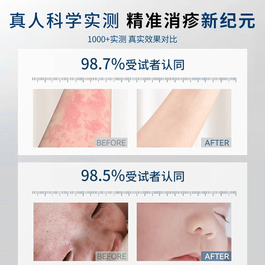 XIBELAON Germany specializes in eczema ointment eczema itchy skin dermatitis dermatitis fungal infection antipruritic cream special gel