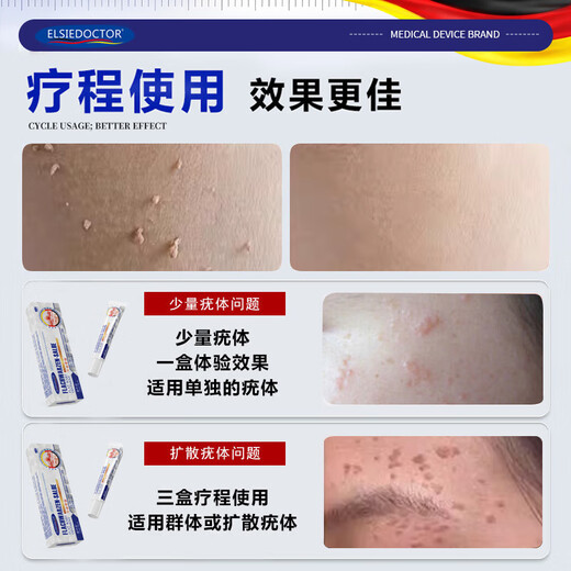 
ELSIEDOCTOR Pharmaceutical Wart Removal Cream Flat Warts Special Plantar Warts Acupuncture Warts Silk Warts Warts Spirit Neck Small Meat Neck