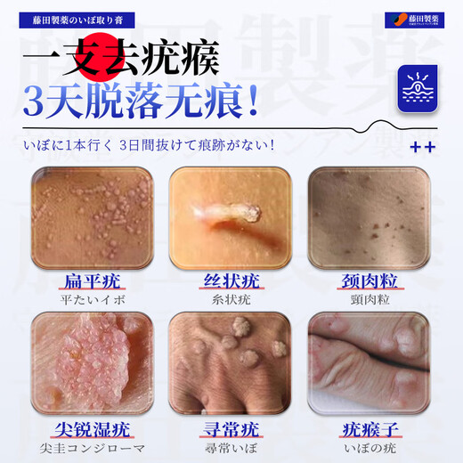 
Fujita Pharmaceutical Wart Removal Body Loss Flat Warts Special Stream Warts Genital Warts Plantar Warts Wart Removal Neck Neck 1 Box