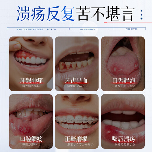 
Honda Pharmaceutical Oral Ulcer Spray Oral Ulcer Inflammation on Fire Foaming Oral Aphrodisiac Antibacterial Anti-inflammatory Pain Relieving Swelling 1 box