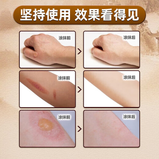 Yunzutang burn ointment for blistering, red and swollen wounds