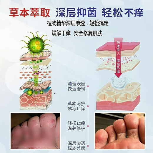 Yunnan herbal athlete's foot spray 60ml anti-itching, peeling, rotten feet, fungal infection, self-operated blister foot stinky sweat foot antibacterial spray
