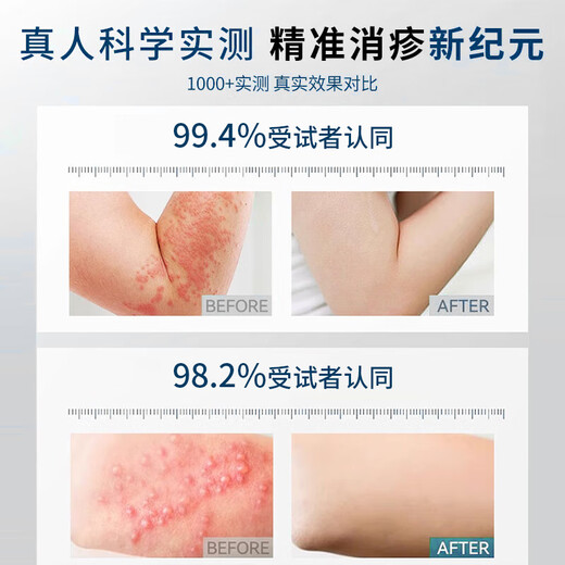 XIBELAON Germany specializes in eczema ointment eczema itchy skin dermatitis dermatitis fungal infection antipruritic cream special gel