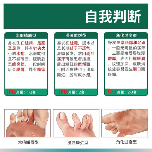 Yunnan herbal athlete's foot spray 60ml anti-itching, peeling, rotten feet, fungal infection, self-operated blister foot stinky sweat foot antibacterial spray