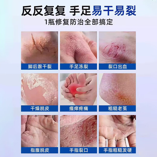 Baiyunshanwei E urea cracked rod foot crack cream heel dry crack crack anti-crack cream to improve rough hand and foot hand cream 30g