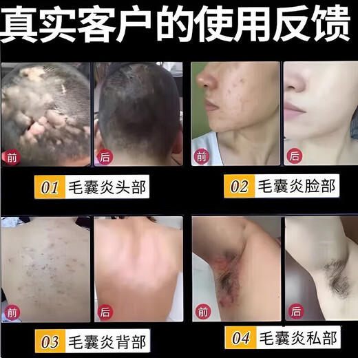 Folliculitis head medicine Folliculitis ointment Itchy scalp with pimples and redness Pimples and pustules on the head Scalp hair follicle medicine Inflammation special new validity period medicine Erythromycin ointment 3 boxes No itching anymore Highly recommended by patients Jingdong Pharmacy Official flagship store authentic Jingdong Pharmacy