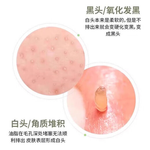 Scrape away blackheads. Portable blackhead scraper. Manual acne facial cleansing hair follicles and pores. Blackhead spatula scraper. Small blackhead spatula for face shaving. Portable. 1 pack. Scrape away blackheads + say goodbye to strawberry nose. Mini beauty spatula.