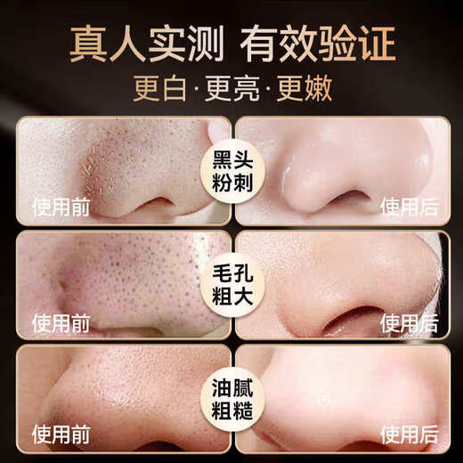 Xiaomi 2025 new blackhead shovel removes blackheads and cleans artifacts, ultrasonic beauty instrument, skin shovel machine, pore cleaning instrument, ultrasonic blackhead instrument, standard version