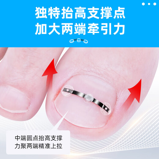 Foot doctor foot fixator, paronychia corrector, ingrown toenail special nail patch, toenail long flesh
