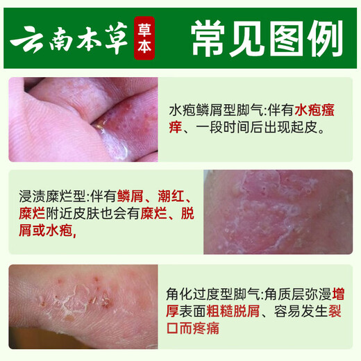 Yunnan herbal athlete's foot, smelly feet, itchy peeling feet, fungal infection spray 60ml + cream 20g skin antibacterial agent set