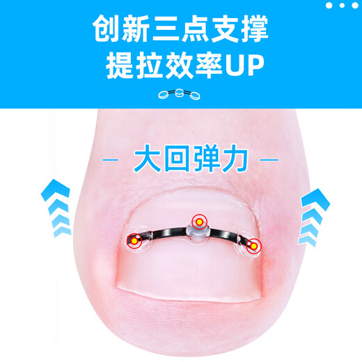 Foot doctor foot fixator, paronychia corrector, ingrown toenail special nail patch, toenail long flesh