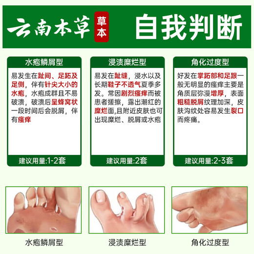 Yunnan herbal athlete's foot, smelly feet, itchy peeling feet, fungal infection spray 60ml + cream 20g skin antibacterial agent set