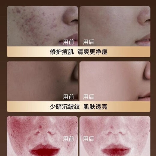 KONKA Mask Beauty Instrument Large Bar Light Red Yellow Blue Acne Remover Photon Rejuvenation Artifact Home Facial Whitening Mask Tail Cargo Machine Quality Barrier/28 Days to Reshape Skin Age/Ten Years Black Pearl Spectrum Model-28 Days Repair-Phototherapy to Create Young Skin