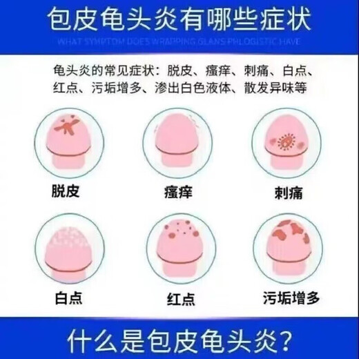 Mupirocin ointment, a special medicine for leucocephalitis, relieves itching, anti-inflammatory, fungal infection, private postdermatitis, skin redness, swelling, erosion, ulcers, pearl rash, dermatitis medicine, 1 box, Mupirocin ointment, authentic Chinese medicine, approved by Chinese medicine, OTC same-day pharmacy delivery