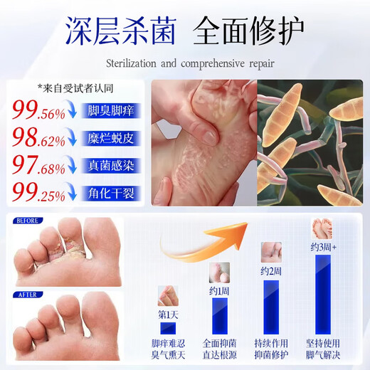 Layanana athlete's foot spray to relieve itching, peeling, rotten feet, fungal infection, smelly feet, itchy feet, improve foot antibacterial spray 60ML