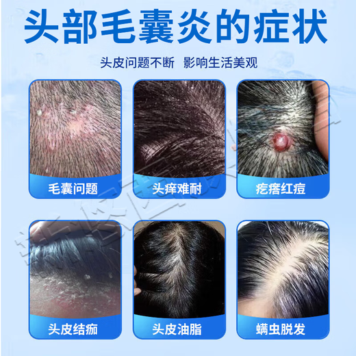 Folliculitis head medicine Folliculitis ointment Itchy scalp with pimples and redness Pimples and pustules on the head Scalp hair follicle medicine Inflammation special new validity period medicine Erythromycin ointment 3 boxes No itching anymore Highly recommended by patients Jingdong Pharmacy Official flagship store authentic Jingdong Pharmacy