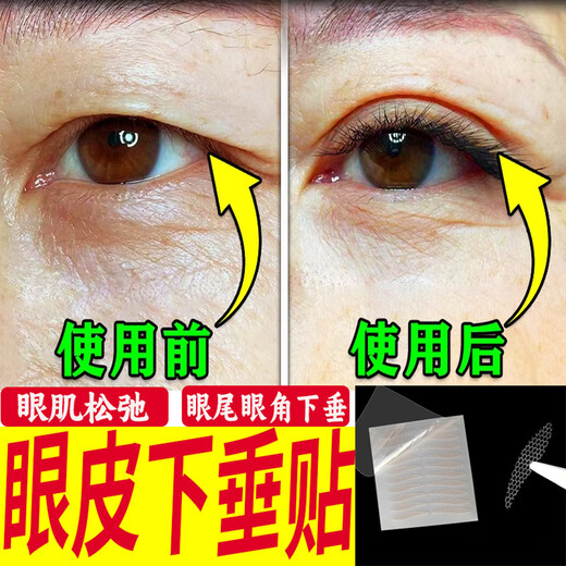 Miss Youya special eyelid lifting patch for middle-aged and elderly people, a magic device for relaxing eye muscles, weak eye size correction patch, invisible eyelid lifting patch for men and women, drooping eyelid lifting 200 patches, delivery, watering bottle + tweezers/tools