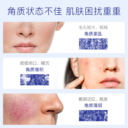 TAKAMI Double 11 spot small blue bottle essence 60ml, cuticle repair, acne removal, closed mouth, sensitive skin, hydrating and moisturizing