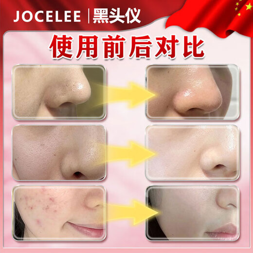 Qiaocheng blackhead suction instrument cleaner beauty salon special household large suction blackhead acne cleaning artifact for men and women white standard model vacuum negative pressure / suck out blackheads