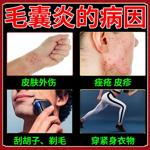 Folliculitis head medicine Folliculitis ointment Itchy scalp with pimples and redness Pimples and pustules on the head Scalp hair follicle medicine Inflammation special new validity period medicine Erythromycin ointment 3 boxes No itching anymore Highly recommended by patients Jingdong Pharmacy Official flagship store authentic Jingdong Pharmacy