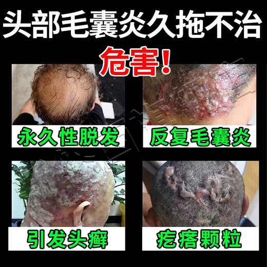 Folliculitis head medicine Folliculitis ointment Itchy scalp with pimples and redness Pimples and pustules on the head Scalp hair follicle medicine Inflammation special new validity period medicine Erythromycin ointment 3 boxes No itching anymore Highly recommended by patients Jingdong Pharmacy Official flagship store authentic Jingdong Pharmacy