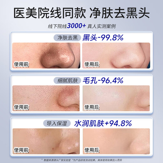 Sawang Instrumento de espinilla profesional alemán para absorber espinillas, pequeñas burbujas, poros y limpiador profundo de acné, removedor de espinillas eléctrico, succión súper fuerte, pequeñas burbujas, instrumento de belleza para circulación de agua, versión exclusiva, vibración ultrasónica + estiramiento profundo EMS + eliminación de espinillas/limpieza facial, vibración de alta frecuencia de 100 W, limpieza profunda de poros