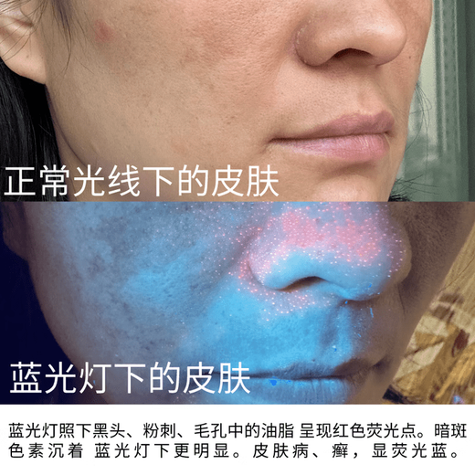 Skin detector, blackhead, acne and grease lamp, fungus and ringworm diagnosis, facial lighting, cosmetics, fluorescent flashlight, skin detection lamp, diamond-encrusted model, rechargeable model 20W