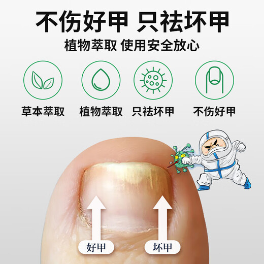 Chunchuntang Yunnan Herbal Onychomycosis Special Effect Chinese Herbal Antibacterial Liquid Thickening and Yellowing Hollow Onychomycosis Care Box