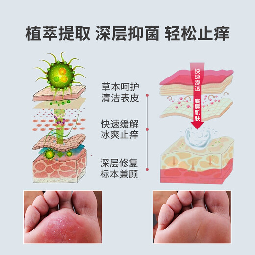 Chunchuntang Yunnan Materia Medica athlete's foot spray sweaty feet, smelly feet, itchy feet, soaked feet, peeling shoes, smelly external use set