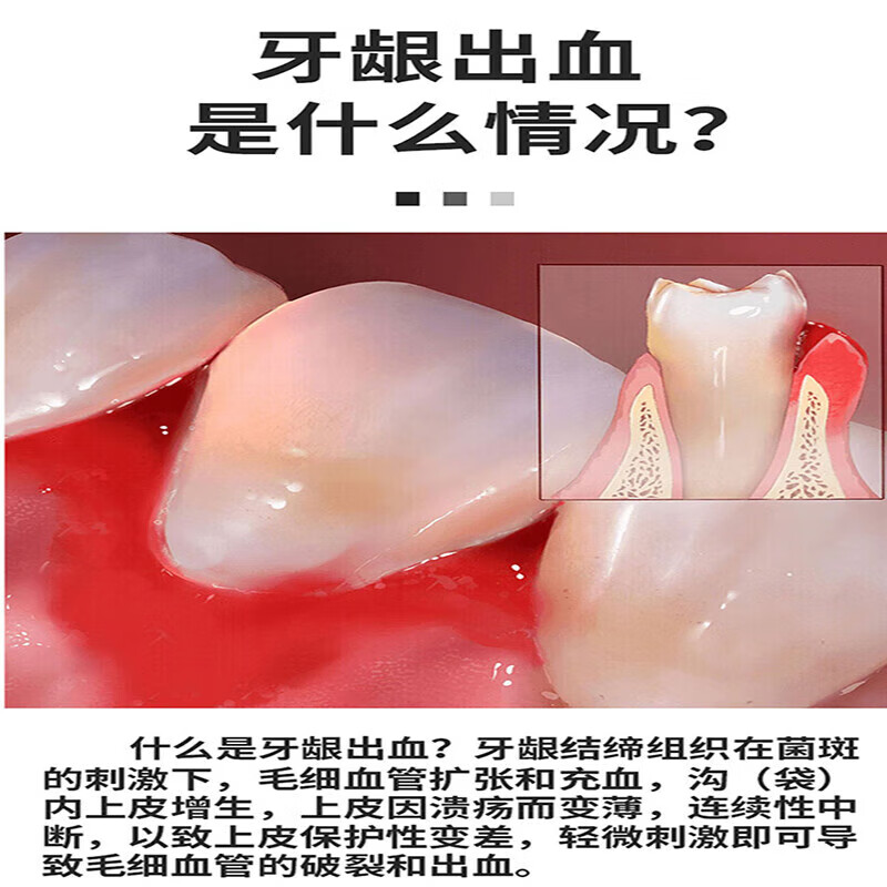 Special toothpaste for sensitive teeth, swollen, painful gums and bleeding gums. Special toothpaste for tooth pain, anti-inflammation, sterilization, swelling, pain relief, and bad breath removal. Two packs. Big discount.