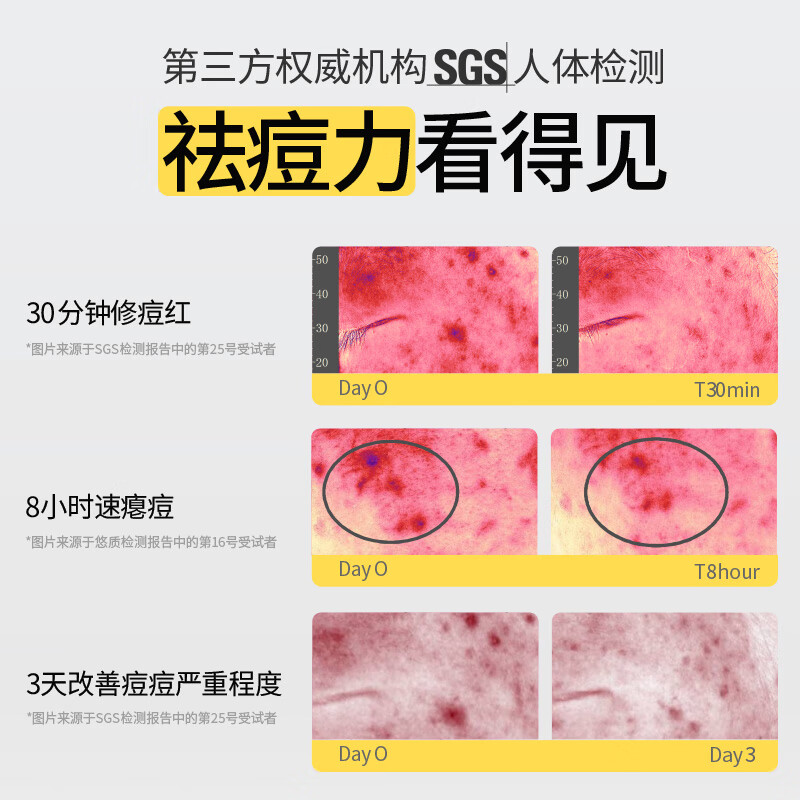 Yusu Anti-Acne Big Bulb 3.0 Chen Meng recommends staying up late for acne, aunt acne skin care products, student acne gifts