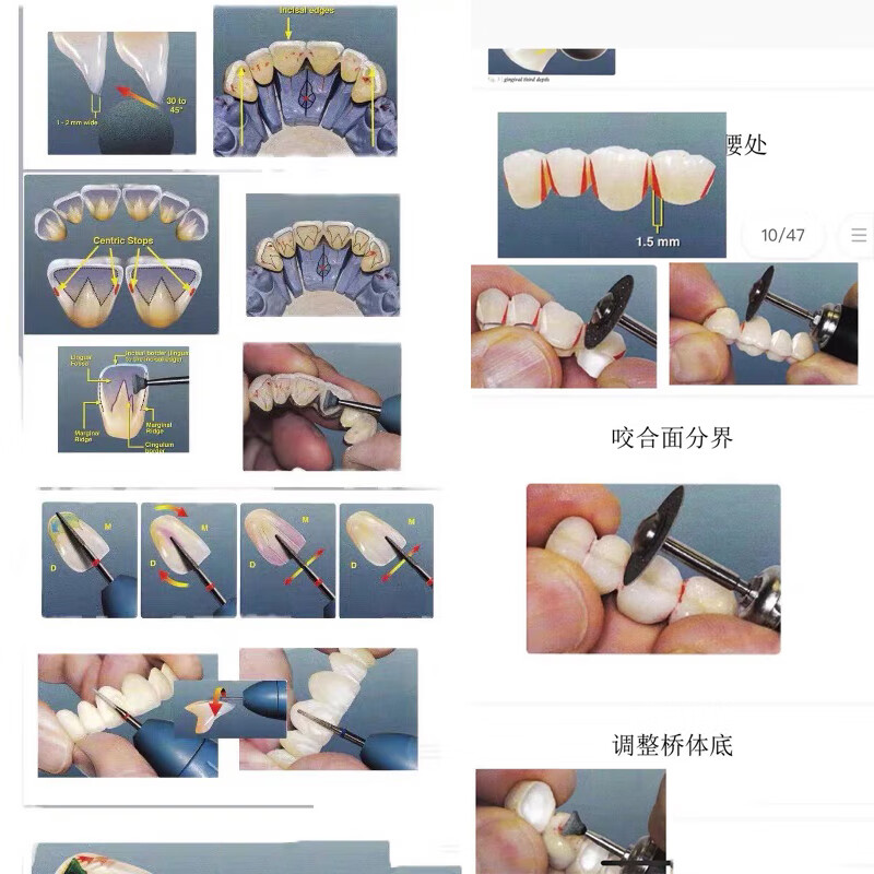 Turning porcelain, dentures, morphological aesthetics, 2025 latest technical information with detailed steps, take a photo and send the complete set of information