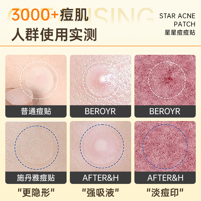 SEEDONVEUR medical research acne patch absorbs pus, invisible concealer, anti-acne, cute star acne patch, can be used for makeup, ultra-thin 160 patches