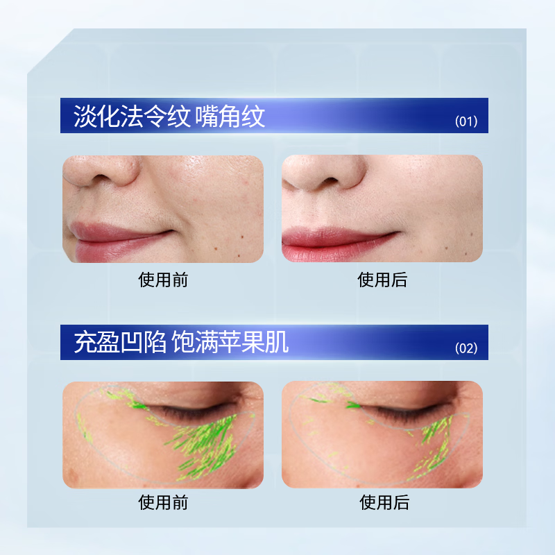 SDX Bose light lines patch to dilute nasolabial folds patch to lift wrinkles around the mouth at night special no-wash for men and women buy two get one free