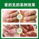Correct onychomycosis antibacterial liquid, non-special effect, deck thickening and discoloration, nail groove fungal infection, impatiens sterilization and nail removal, 2 bottles of onychomycosis antibacterial liquid, moderate, no problem